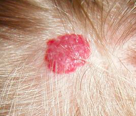 HEMANGIOMA 2.png