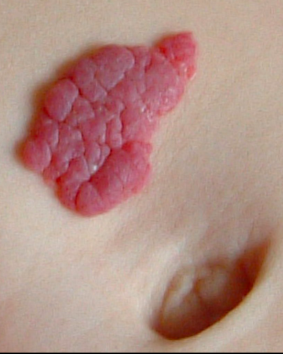 HEMANGIOMA 1.png