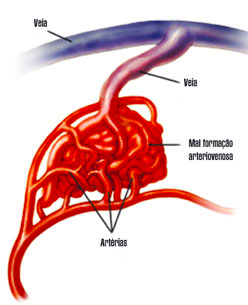 malformação arterio venosa 2.png