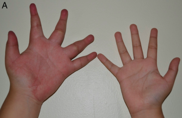 MALFORMAÇÃO ARTERIO VENOSA 1 .png