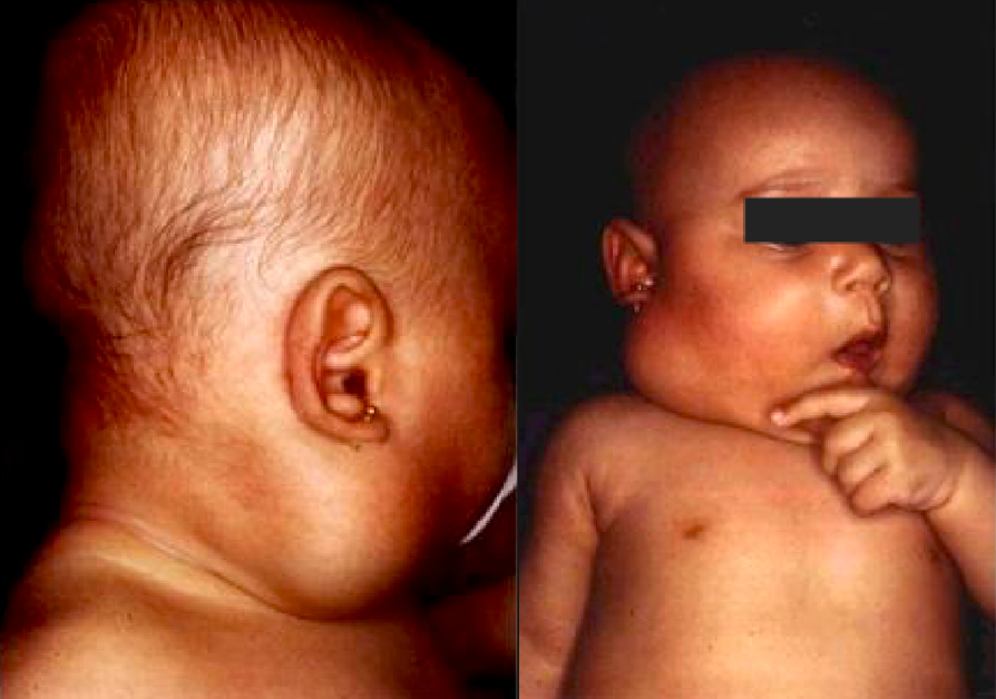 LINFATICA 2 CORRETA.png