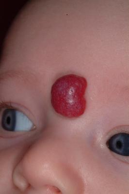 hemangioma_5.jpg