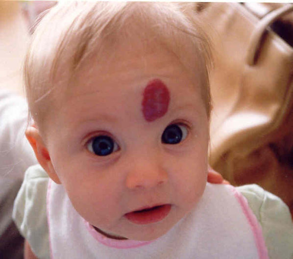 hemangioma_1.jpg